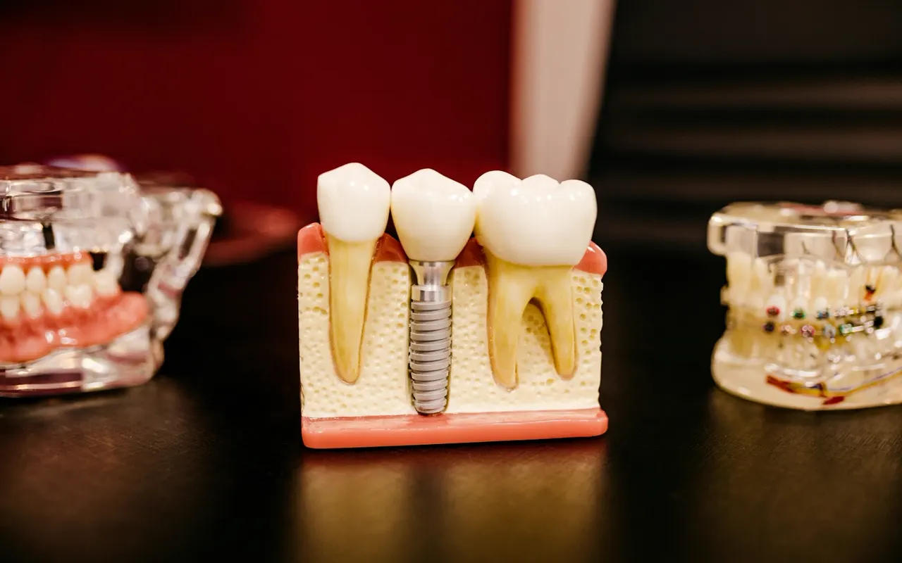 Implantes dentários